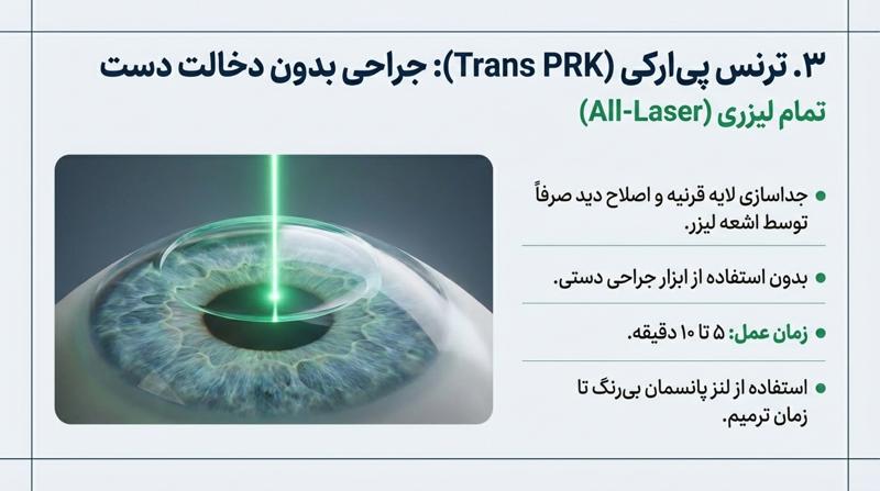 جراحی ترنس پی آر کی برای نزدیک بینی